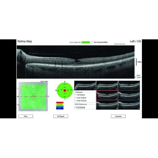 OCT Visionix Optovue iVue 80