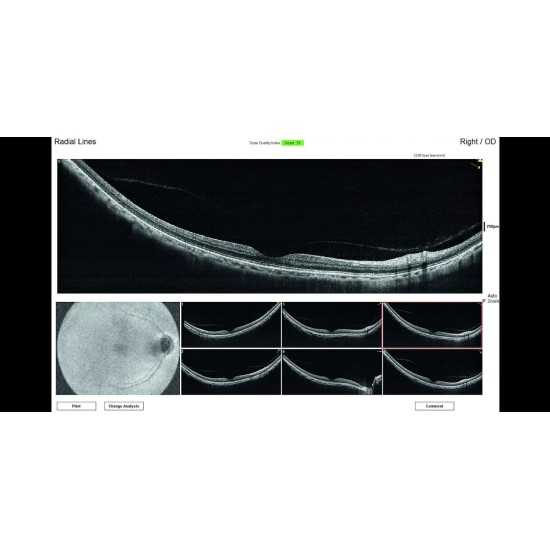 OCT Visionix Optovue iVue 80